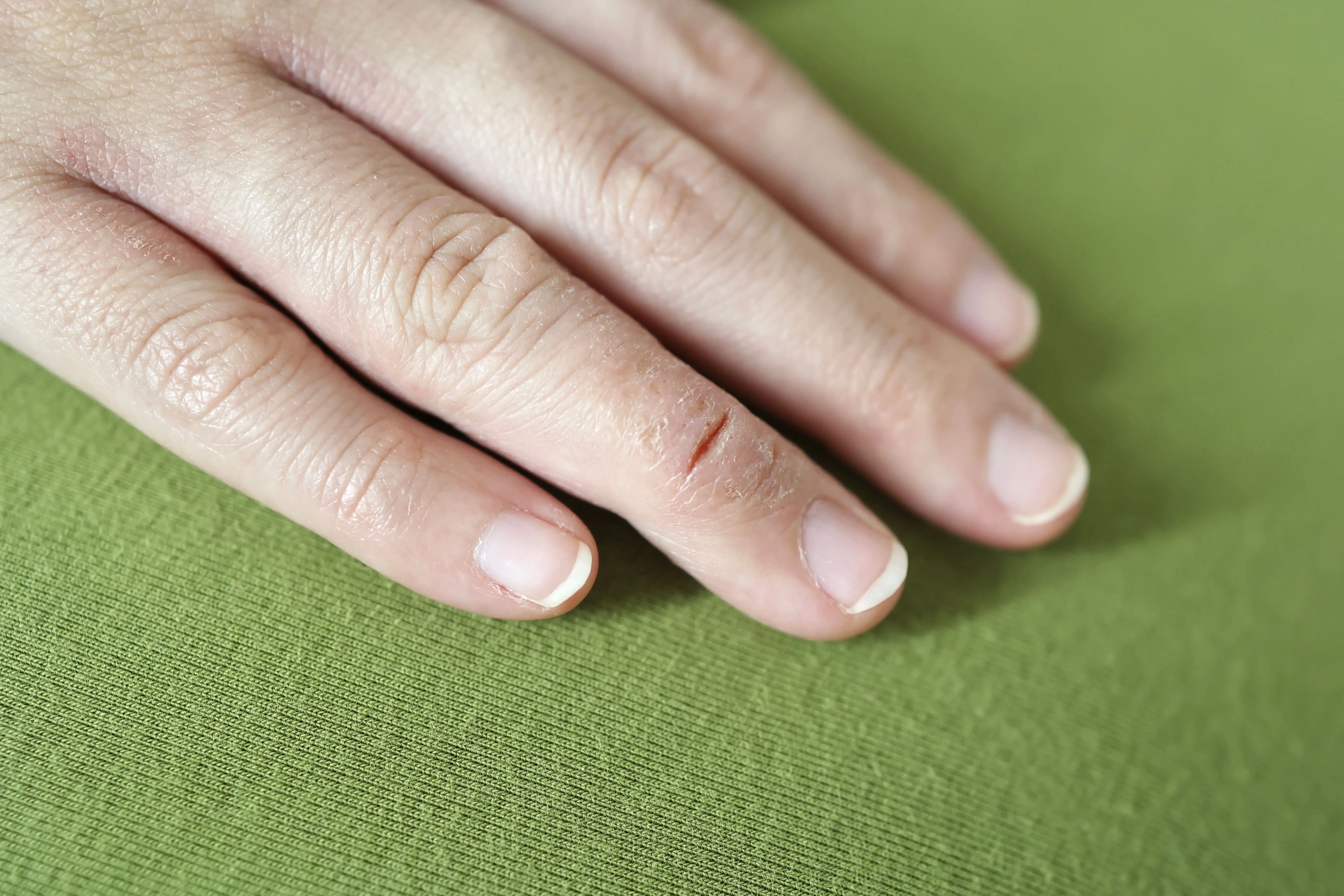 ひび割れ・あかぎれの原因と対策｜つらい症状を改善し予防する方法